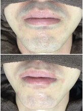 ミランオオサカ(MIRAN OSAKA)/メンズ ひげ脱毛