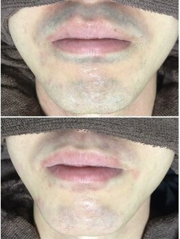 ミランオオサカ(MIRAN OSAKA)/メンズ ひげ脱毛