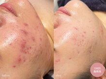 ラティエ(Latier)/3ヶ月でこのお肌変化！！