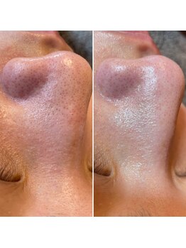 ルピナス(Lupinus)/毛穴洗浄、角質除去!