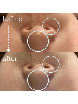 ディースズ(D.suzu)/ハイドロ毛穴洗浄before/after