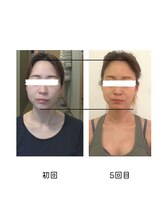 サリー(Sally)/小顔・たるみケア