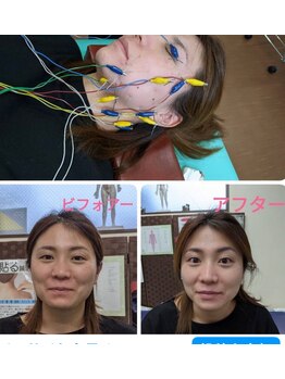 大勝鍼灸整骨院プライマリィ/電気美容鍼　ビフォー・アフター