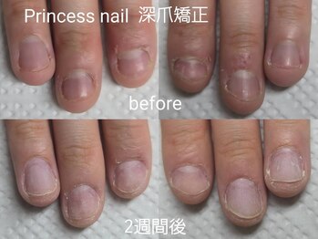 プリンセスネイル(Princess nail)/深爪矯正2週間の変化!