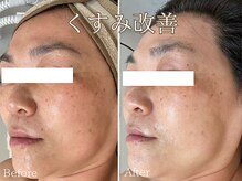 シエナ(ciena)/BBL光フェイシャル症例写真♪