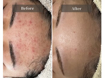 エミルカ 天王寺店(EMILUCA)/ニキビ0のおでこ