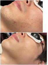 グロー(GLOW)/メンズヒゲ脱毛