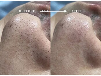 ノート(Naught)/CANAEL式毛穴エクストラ洗浄　鼻