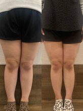 長寿鍼灸院 長寿整骨院/EMS＜太もも集中コース＞