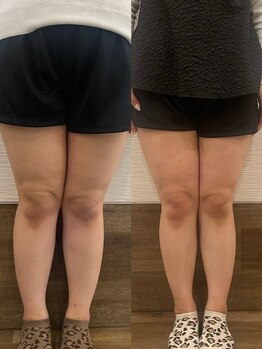 長寿鍼灸院 長寿整骨院/EMS<太もも集中コース>