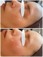 カレント(current)/ハーブピーリング¥8800