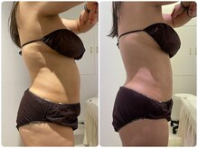 イデアルミー 大宮店(イデアルMe)/1回目施術Before after