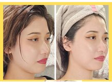 アン 銀座(ann)/レモンボトル１回目