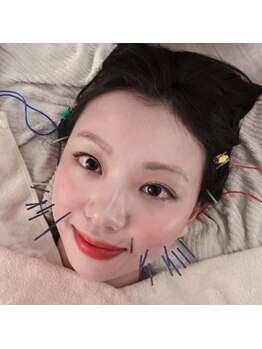 ルソール(Le seul)の写真/【同業者が本気で通う本格"美容鍼"がお勧め】小顔美容鍼＋身体の同日施術もご用意しております！