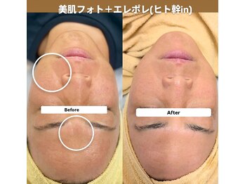 クレール 小山店(CLAIR)/【美肌フォト+エレポレ