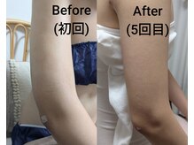 リラージェ 池袋(Relaje)/インディバ/エンダ/術*後ケア