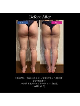 エラ(Ella)の写真/【華奢見せ★すらっと美脚】頑固なセル脂肪に徹底アプローチ!下半身集中ケアコース¥12500→¥9800