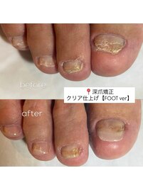 【 深爪矯正】FOOTクリア仕上げ