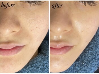 ゴールデンアイ 谷山店(Golden eye)/大人気毛穴ケア★ハイドラ