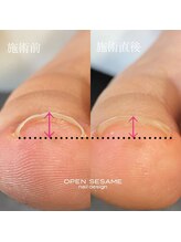 オープンセサミ 練馬/巻き爪ケア