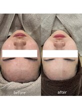 タグ 高知駅前店(Tug)/【美白・毛穴・肌荒れ】剥離