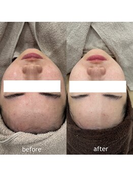 タグ 高知駅前店(Tug)/【美白・毛穴・肌荒れ】剥離