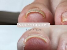 ミンスネイル(Mins Nail)の雰囲気（巻き爪改善！ 専用ジェルにより巻き爪改善が出来る♪）