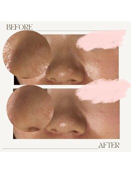 サロン ド ミコラ(salon de Micora)/次世代美容液毛穴洗浄