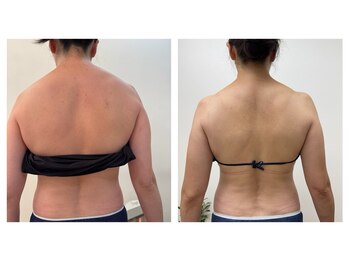 ルミエール 新宿御苑/背中脇肉脂肪!本気痩身!