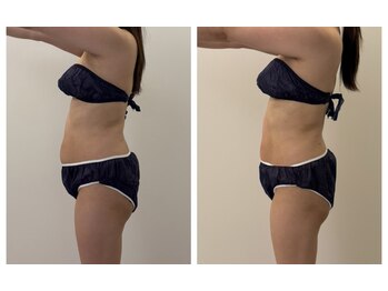 ナチュラル ユース(Natural youth)/横のシルエット1回でこの変化！