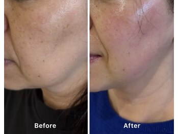 ベル(Belle)/50代女性beforeafter