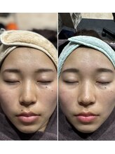 セントラル鍼灸院リラクシー(Re:laxy)&nbsp;電気美容鍼 整顔