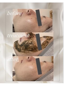 ミラリア(mirallia)の写真/変わる肌を実感。miralliaのハーブピーリングでくすみのない理想の素肌へ♪