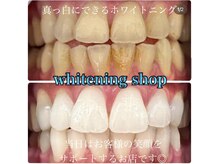 ホワイトニングショップ 柏店/美白ホワイトニング