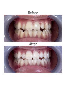 ホワイトニングショップ 静岡店/ホワイトニングBefore→After