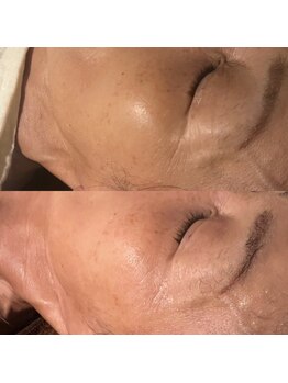 ヨハク 市川店(yohaku)/ハーブピーリング