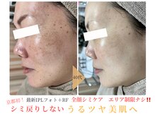 エソア(esoa)/40代　光フォト8回施行