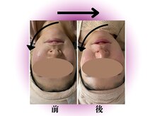 カリアンヌ/リフトアップフェイシャル