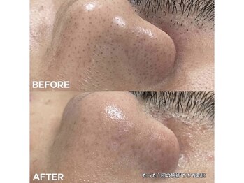 ノート(Naught)/CANAEL式毛穴エクストラ洗浄　鼻