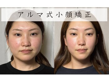 美容整体 アルマ/小顔ゆがみ3ヶ月改善コース