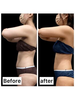 クールヴィラ(Cool Villa)/冷却2回痩身マッサージ6回