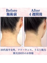 カラフル(caratful)/うなじ脱毛 Before After 