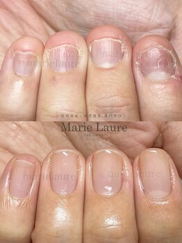 マリーロール 淀屋橋本店(Marie Laure)/自爪育成/深爪矯正/ネイルケア