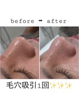 リブ シャルム(Lib Charm)/毛穴洗浄のビフォーアフター★