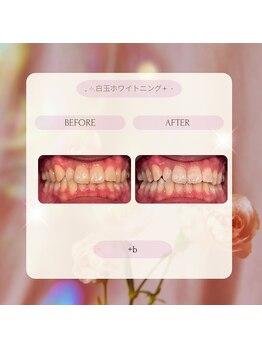 プラスビーセルフ(+b self)/ホワイトニングビフォーアフター