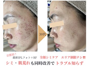 エソア(esoa)/40代 光フォト7回施行