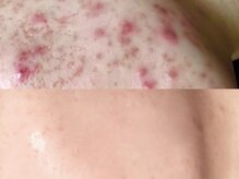 アンドナイン エス店(ANDNINE.)の雰囲気（集中ニキビケアで自信のある素肌美を！ハーブピーリング4回施術）