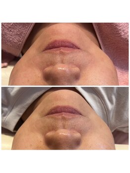 ビューティスト(Beautist)の写真/大人気のメニュー♪ラジオ波×強リンパによるダブル効果★【圧倒的小顔フェイシャル75分¥7800】