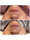 ビューティスト(Beautist)の写真/大人気のメニュー♪ラジオ波×強リンパによるダブル効果★【圧倒的小顔フェイシャル75分¥7800】