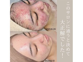 ラ ラナン(La lanun)の写真/繰り返すニキビを根本から直接殺菌☆